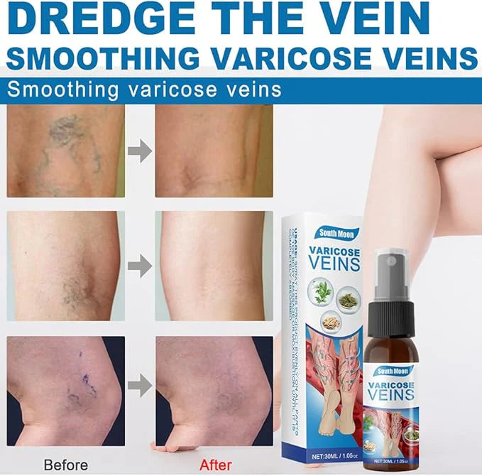 South moon vericose veins spray