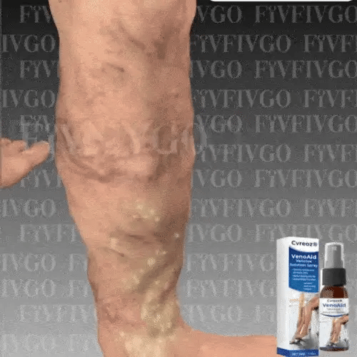 South moon vericose veins spray